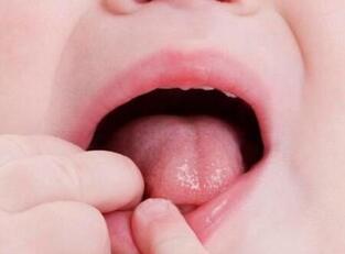 小儿口角炎的症状是什么