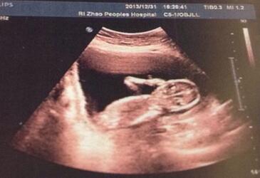 怀孕14周胎儿彩超图