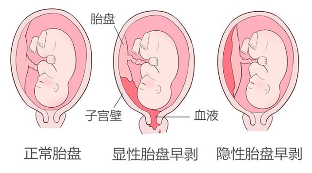 孕晚期腹痛不只是胎动