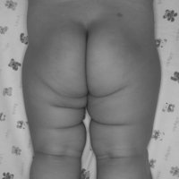 为什么宝宝的臀纹不对称？是髋关节发育不良吗
