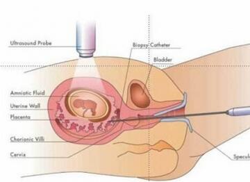 绒毛穿刺和羊水穿刺的区别