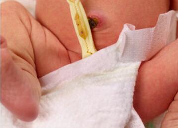 新生儿肚脐发炎症状有哪些？新生儿脐炎怎么办？