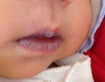 婴儿嘴唇发紫是什么原因