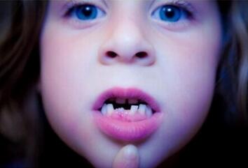 儿童乳牙滞留怎么办