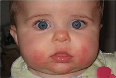 宝宝常见10大皮肤问题及护理心得