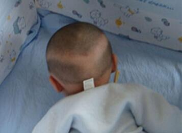 婴儿枕秃原因和预防