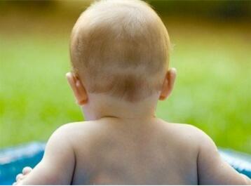 婴儿枕秃原因和预防
