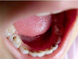 儿童龋齿怎么治疗方法