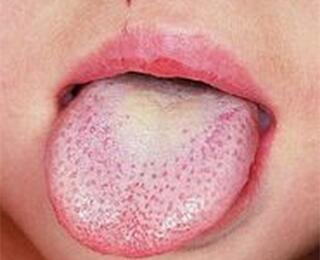 小孩草莓舌是怎么回事？