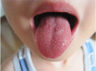 小孩草莓舌是怎么回事？