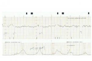胎心监护图怎么看