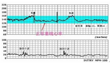 胎心监护图怎么看