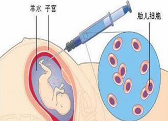 成都羊水穿刺费用多少