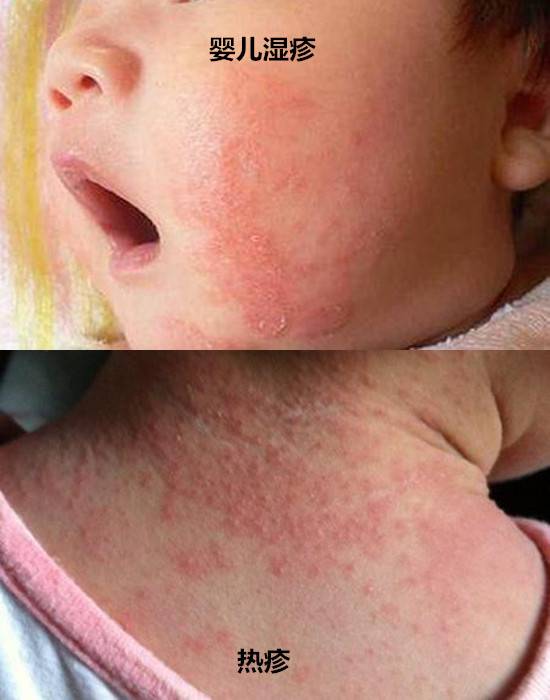 婴儿湿疹和热疹的区别 牢记六大区别不再混淆