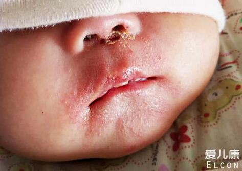 炉甘石洗剂和凡士林能搞定宝宝9种皮肤问题