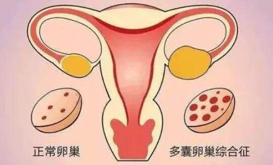 多囊卵巢综合症的症状有哪些