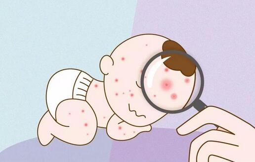 婴儿湿疹高发常见5大原因