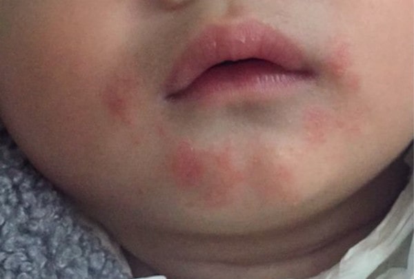 婴儿流口水嘴巴起疹子了，该怎么办？