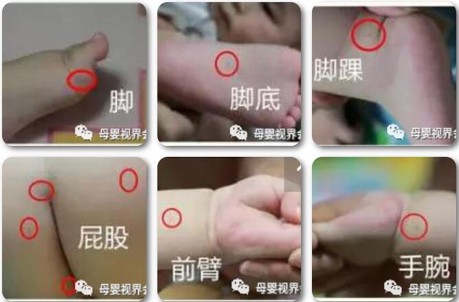 如何预防小儿手足口病