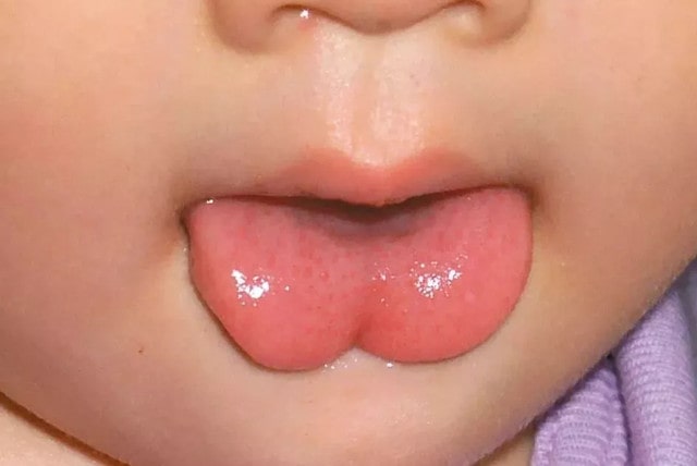 宝宝舌系带过短，一定要手术吗？
