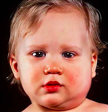 宝宝腮帮子肿了，怎么判断是不是腮腺炎？