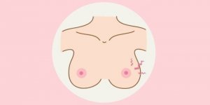 孕期乳晕上有凸起的小疙瘩是怎么回事