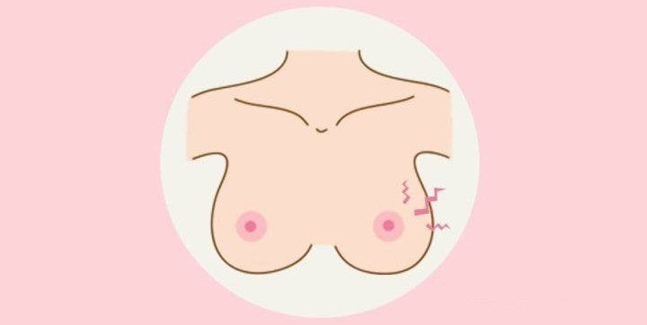 孕期乳晕上有凸起的小疙瘩是怎么回事