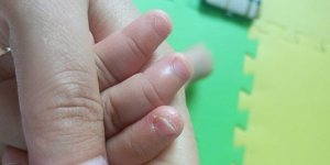 宝宝手指脱皮怎么办？