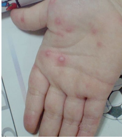 手足口病症状初期图片