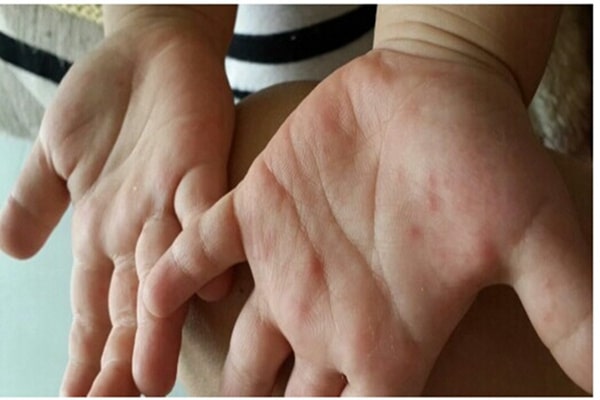 手足口病症状初期图片