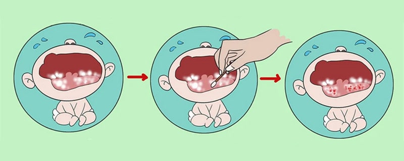 婴儿鹅口疮最佳治疗方法